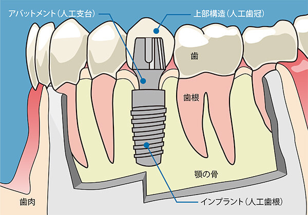 自分の歯と同じように噛めるインプラント