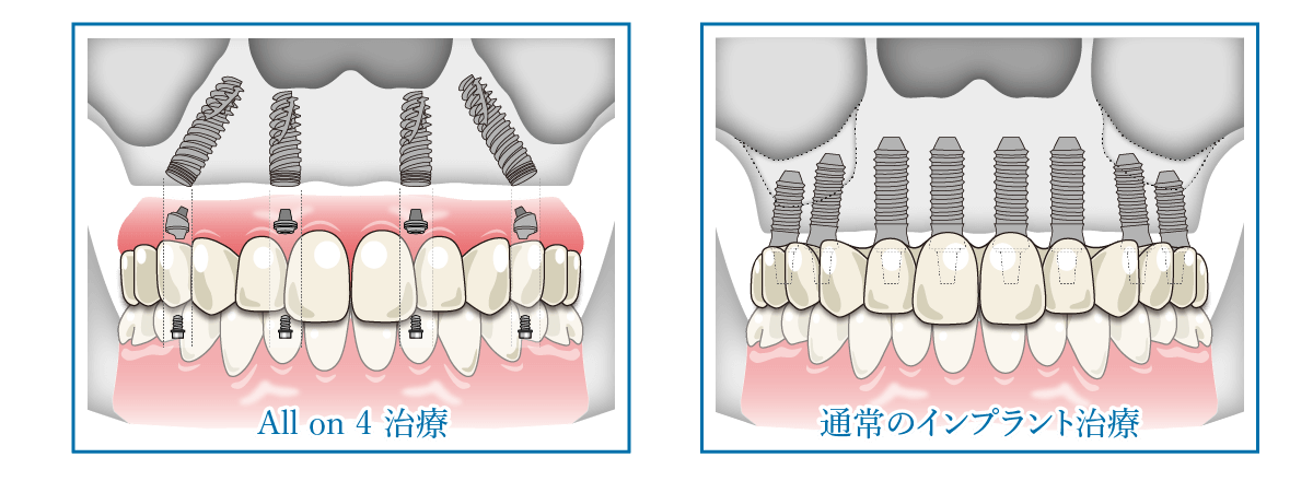 これまでのインプラントとの違い