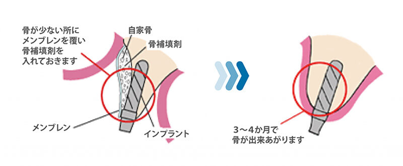 GBR（骨誘導再生療法）