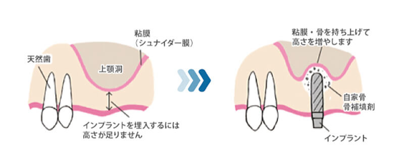 サイナスリフト