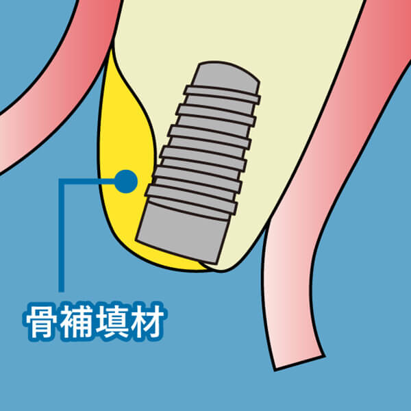 メンブレンをかぶせます