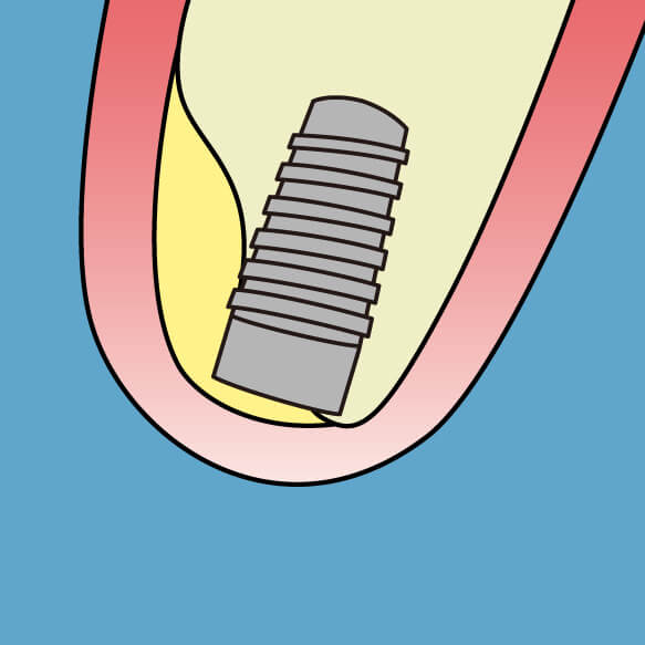 インプラントが安定