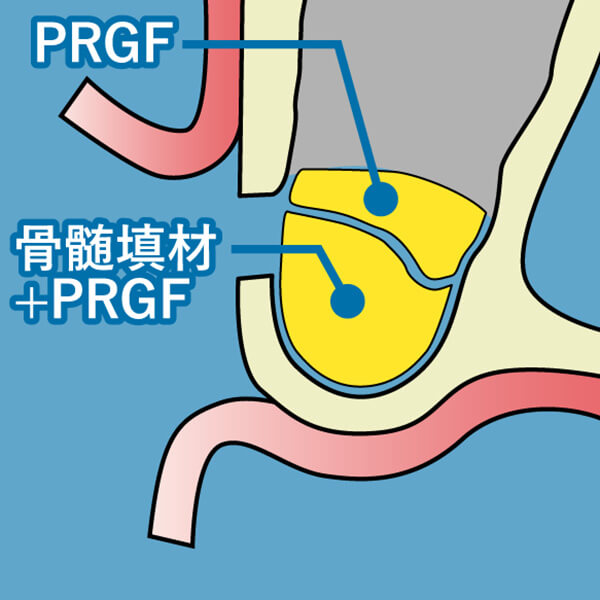 隙間にPRGFと骨補填材を填入