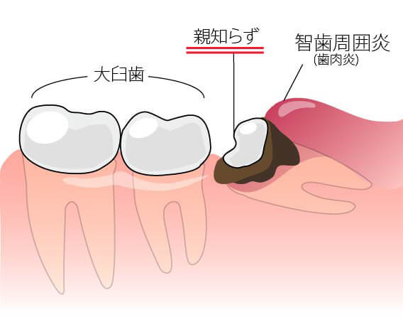 親知らず