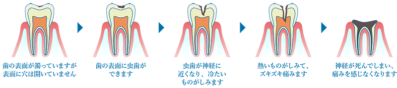 虫歯を放置すると